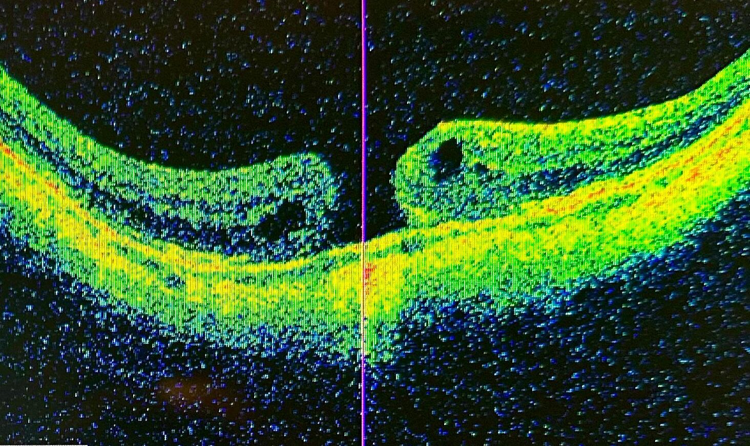 agujero macular